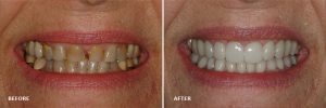 whitening and damaged before and after | Shavano aesthetic dentistry