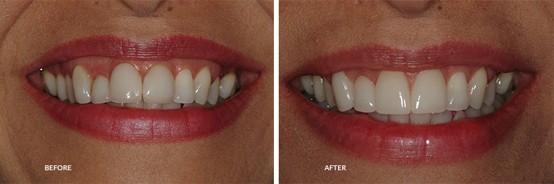 before and after gum realignment | Shavano aesthetic dentistry