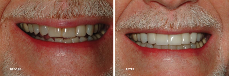 before and after whitening and replacement gallery photos | Shavano aesthetic dentistry