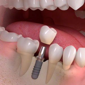 Implant tooth | Dr. Stephen Wood Densitry