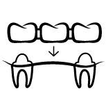 Dental bridges illustration | Dr. Stephen Wood Dentistry
